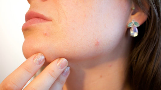 acne scars