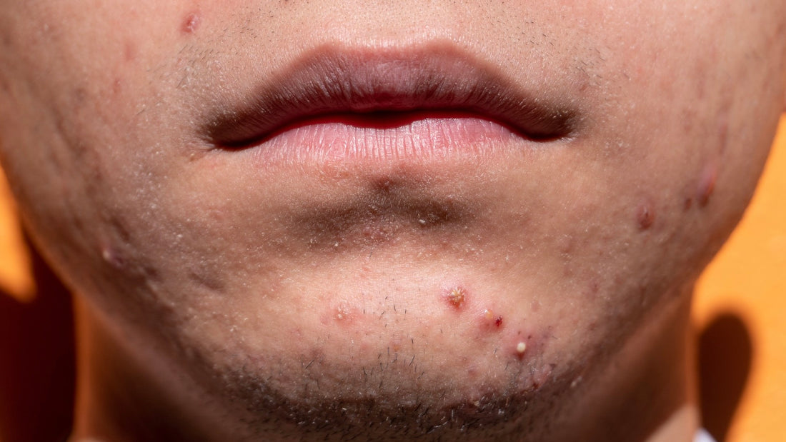 acne scars