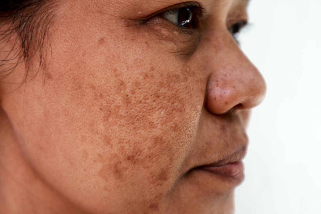 woman with dark spots on her face