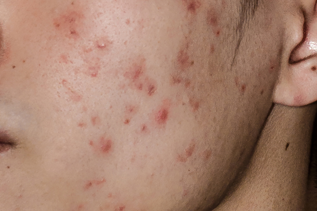 Understanding Skin Textural Irregularities: What Does Textured Skin Me ...