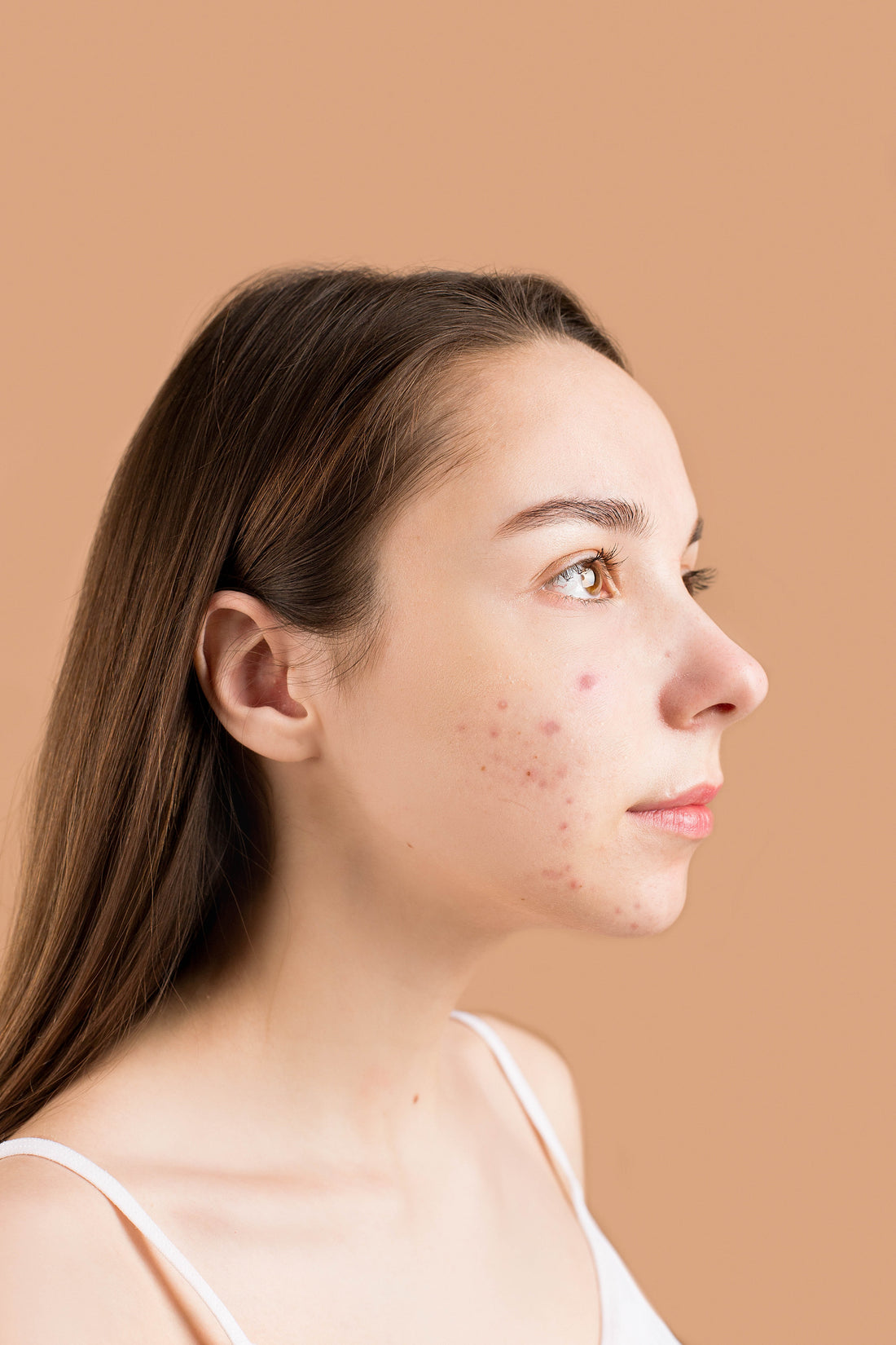 acne scars