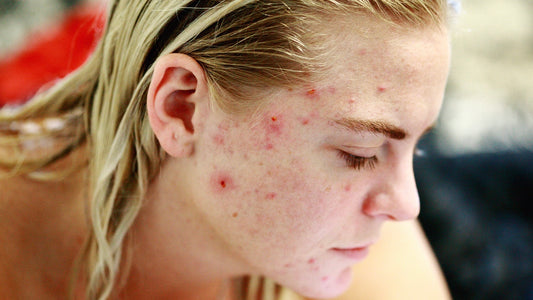 acne scars